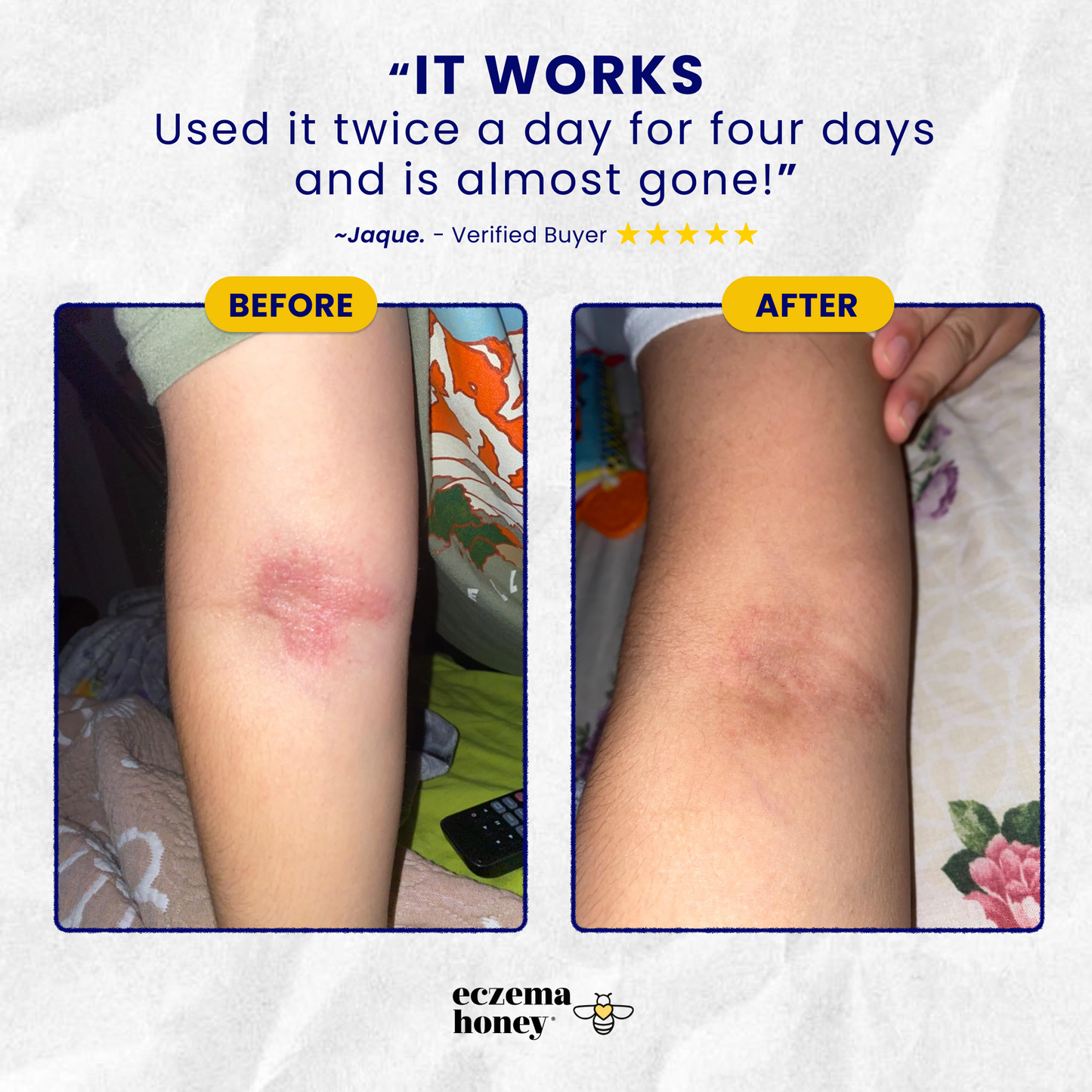 Child Eczema Starter Kit