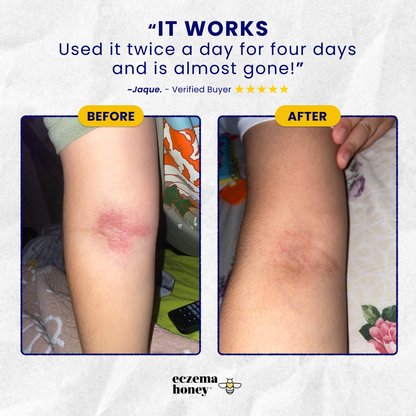 Child Eczema Starter Kit