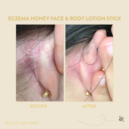 Eczema Honey Gentle Face and Body Lotion Stick
